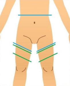 VIO脱毛では太ももやお腹も同時に処理したほうがイイ