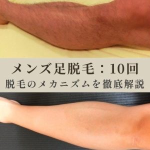 メンズ足脱毛｜10回でツルツルの経過写真：ゆで卵を例に仕組みを徹底解説