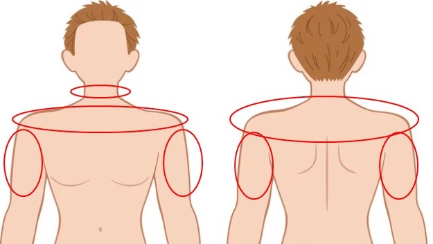 硬毛化のリスクのある部位（肩、肩周り、上腕、首）