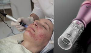 ダーマペンの詳細