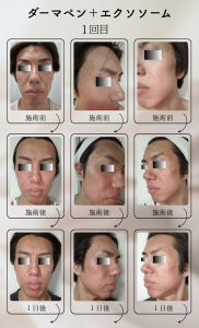ダーマペン＋エクソソーム変化の様子_1回目_01