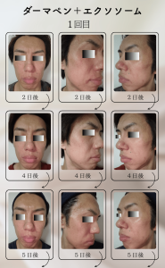 ダーマペン＋エクソソーム変化の様子_1回目_02