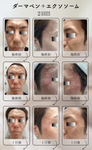 ダーマペン＋エクソソーム変化の様子_2回目_01