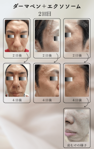 ダーマペン＋エクソソーム変化の様子_2回目_02