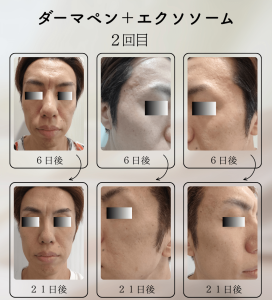 ダーマペン＋エクソソーム変化の様子_2回目_03
