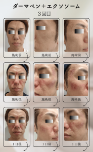ダーマペン＋エクソソーム変化の様子_3回目_01