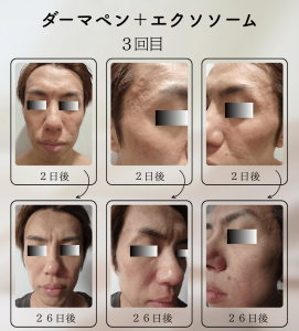 ダーマペン＋エクソソーム変化の様子_3回目_02