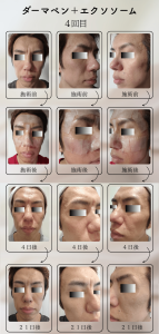 ダーマペン＋エクソソーム変化の様子_4回目