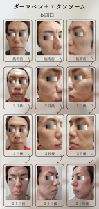 ダーマペン＋エクソソーム変化の様子_5回目