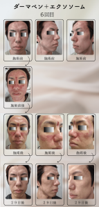 ダーマペン＋エクソソーム変化の様子_6回目