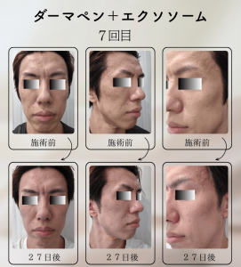ダーマペン＋エクソソーム変化の様子_7回目