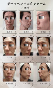ダーマペン＋エクソソーム変化の様子_8回目