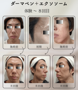 ダーマペン＋エクソソーム変化の様子_体験から8回目