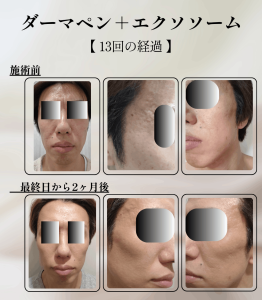 40代男性_ダーマペン13回の経過報告_完了